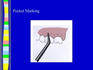 Pocket Marking
 