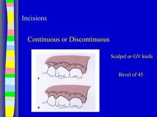 Incisions
Continuous or Discontinuous
Scalpel or GV knife
Bevel of 45
 
