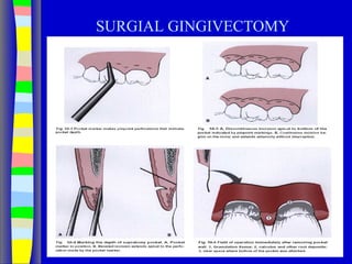 SURGIAL GINGIVECTOMY
 