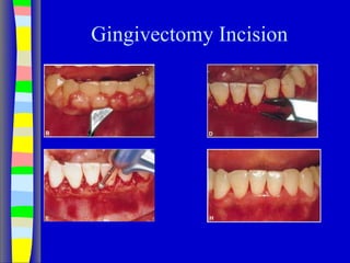 Gingivectomy Incision
 