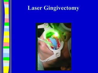 Laser Gingivectomy
 