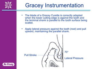 Curettes Clinical Application Guide | PPT