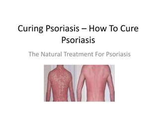 Curing Psoriasis – How To Cure Psoriasis The Natural Treatment For Psoriasis 