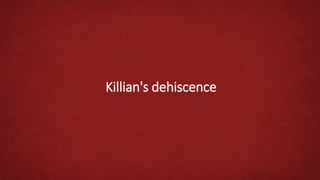 Killian's dehiscence
 