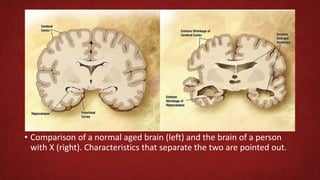 • Comparison of a normal aged brain (left) and the brain of a person
with X (right). Characteristics that separate the two are pointed out.
 