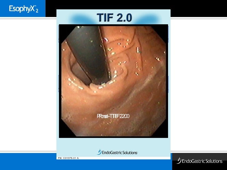 Overview of Endoscopic Gastric Fundoplication