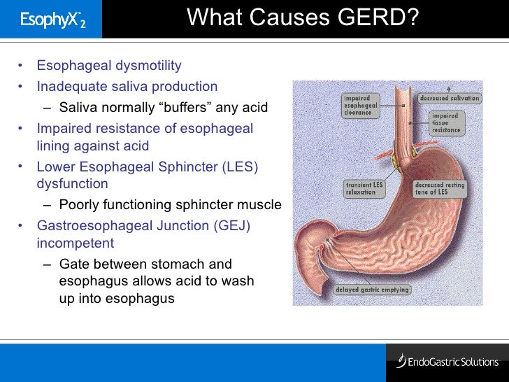 Overview of Endoscopic Gastric Fundoplication