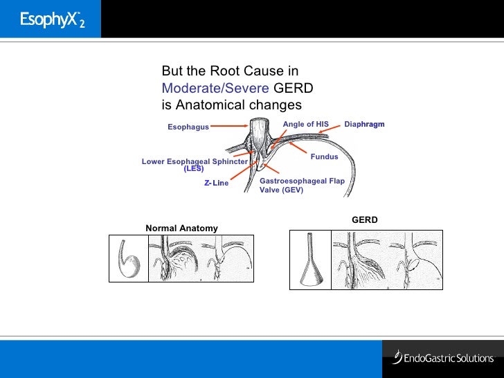Overview of Endoscopic Gastric Fundoplication