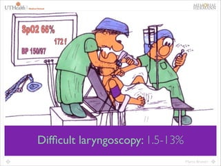 27

Difﬁcult laryngoscopy: 1.5-13%
Marco Brunori

 