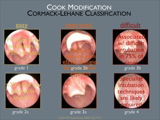 COOK MODIFICATION	

CORMACK-LEHANE CLASSIFICATION
easy
Predicts easy
intubation in
95% of cases	

!

grade 1
!
!

restricted

Likely to
require gum
elastic bougie,
butgrade other
no 2b
adjuncts

<3% need any
intubation
adjuncts
grade 2a

grade 3a
Cook TM; Anesthesia 2000; 55:274-9

difﬁcult
Associated
w/ difﬁcult
intubation
in 75% of
cases	

grade 3b
!

Specialist
intubation
techniques
are likely
required
grade 4

 