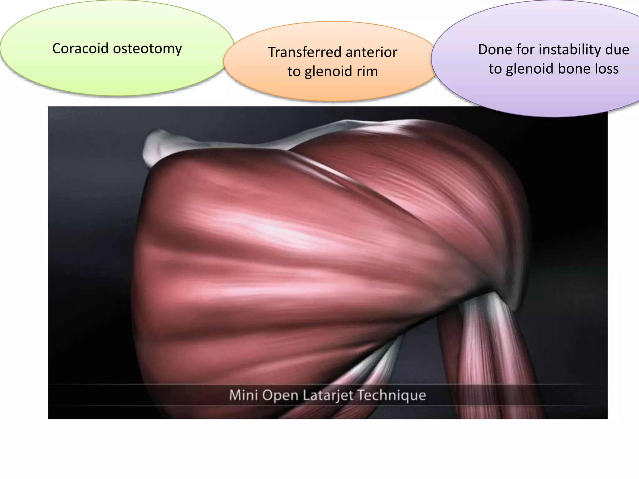 Coracoid osteotomy Transferred anterior
to glenoid rim
Done for instability due
to glenoid bone loss
 