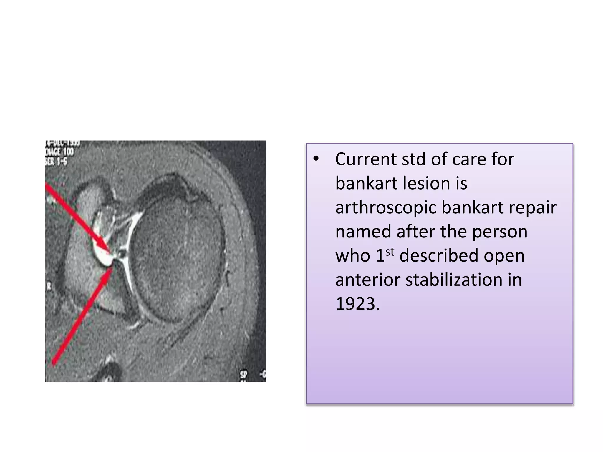 • Current std of care for
bankart lesion is
arthroscopic bankart repair
named after the person
who 1st described open
anterior stabilization in
1923.
 