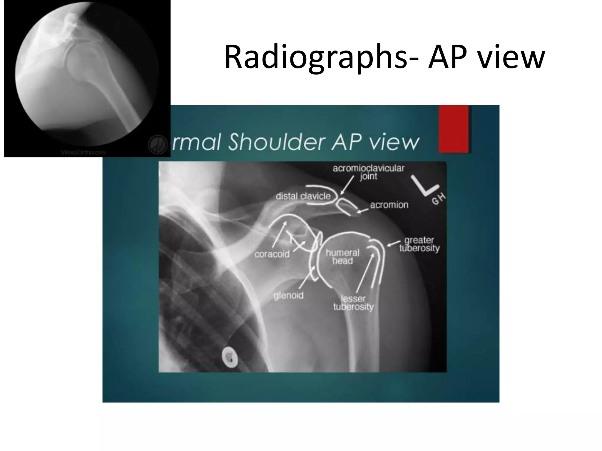 Radiographs- AP view
 