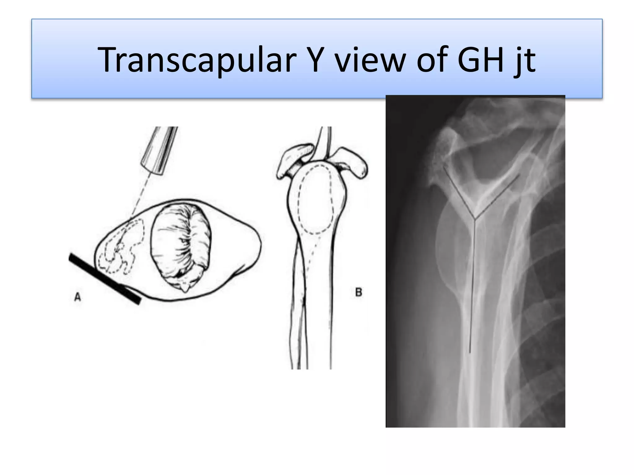 Transcapular Y view of GH jt
 