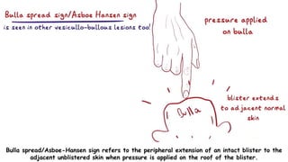 Current Concepts Of Pemphigus With A Deep Insight Into Its Molecular Current Concepts Of Pemphigus With A Deep Insight Into Its Molecular