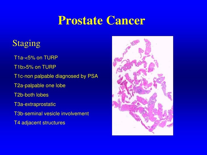 management of prostate cancer pdf