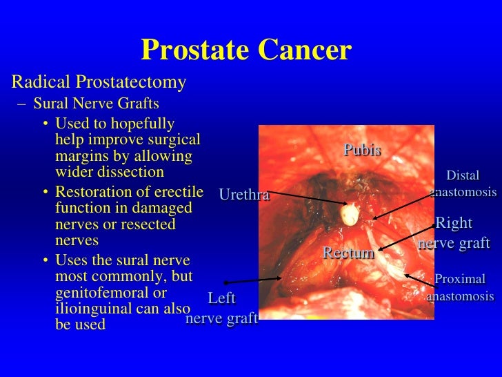 Current Diagnosis And Management Of Prostate Cancer