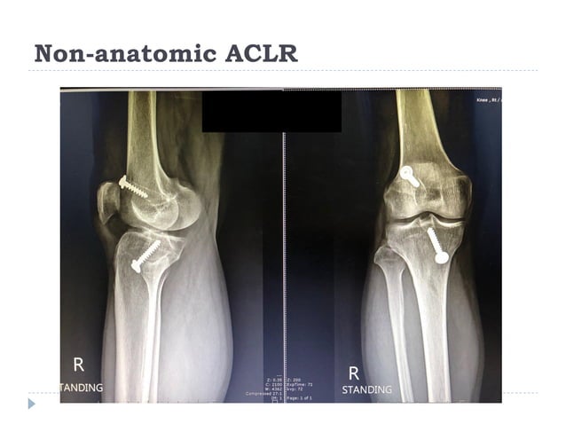 Current management of ACL injury 2017 | PDF