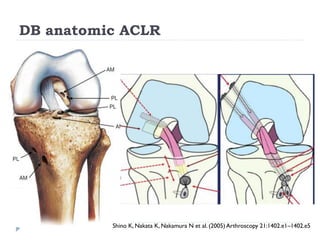 Current management of ACL injury 2017 | PDF