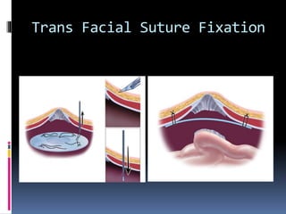 Transfixation Incision Current management of incisional hernia | PPTX