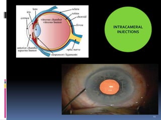 Trochlear Injection OCCULAR DRUG DELIVERY SYSTEM | PPTX