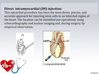 Direct intramyocardial (IM) injection:
This epicardial procedure has been the most direct, precise, and
accurate approach for injecting stem cells to an infarcted region of
the heart. The location can be identified pre-operatively using
echocardiography and nuclear imaging and, during surgery, by
empirical observation.
 