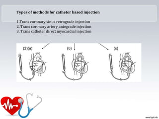 Types of methods for catheter based injection
1.Trans coronary sinus retrograde injection
2. Trans coronary artery antegrade injection
3. Trans catheter direct myocardial injection
 