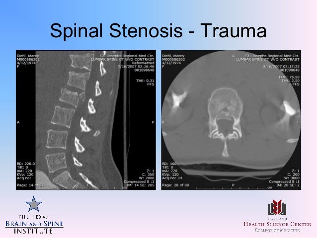 Neurontin Spinal Stenosis