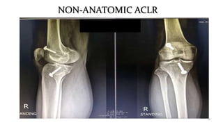 NON-ANATOMIC ACLR
14
 