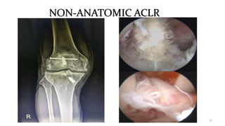NON-ANATOMIC ACLR
15
 