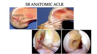 SB ANATOMIC ACLR
17
 