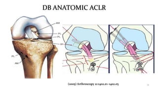 DB ANATOMIC ACLR
19(2005) Arthroscopy 21:1402.e1–1402.e5
 