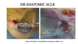 DB ANATOMIC ACLR
20Rainer Siebold’s C Type Ribbon Technique ESSKA 2014
 