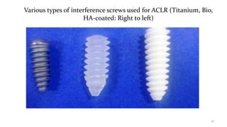 Various types of interference screws used for ACLR (Titanium, Bio,
HA-coated: Right to left)
24
 