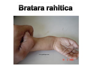Curs 18,19 malnutritia si rahitismul (1) | PPT