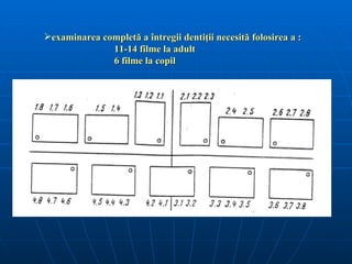 examinarea completă a întregii dentiţii necesită folosirea a :
              11-14 filme la adult
              6 filme la copil
 