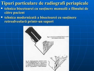 Tipuri particulare de radiografi periapicale
   tehnica bisectoarei cu susţinere manuală a filmului de
    către pacient
   tehnica modernizată a bisectoarei cu susţinere
    retroalveolară printr-un suport
 