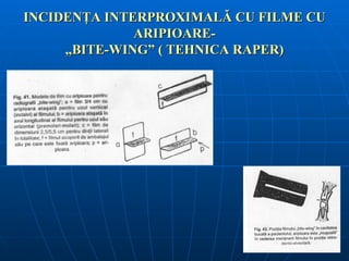 INCIDENŢA INTERPROXIMALĂ CU FILME CU
              ARIPIOARE-
     „BITE-WING” ( TEHNICA RAPER)
 