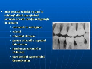    prin această tehnică se pun în
    evidenţă dinţii aparţinând
    ambelor arcade (dinţii antagonişti
    în ocluzie)
          coroanele în întregime

          coletul

          rebordul alveolar

          partea ocluzală a septului

           interdentar
          jumătatea coronară a

           rădăcinii
          parodonţiul segmentului

           dentoalveolar
 