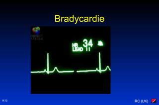 RC (UK)K10
Bradycardie
 