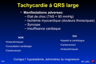 RC (UK)K28
Tachycardie á QRS large
• Manifestations adverses:
– Etat de choc (TAS < 90 mmHg)
– Ischémie myocardique (douleurs thoraciques)
– Syncope
– Insuffisance cardiaque
NON
•Antiarythmiques
•Consultation cardiologie
•Cardioversion
OUI
•Appelle le cardiologue
•Cardioversion
•Antiarythmiques
Corrigez l’ hypokaliémie, administrez du magnesium
 