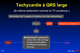 RC (UK)K29
Administrez de l’ oxygène et obtenez une voie intraveineuse
Pouls? NON Utilises le protocole FV
OUI
Manifestations adverses?
• Choc (TAs <90 mm Hg)
• Douleurs précordiales
• Insuffisance cardiaque
• Syncope
OUINON
Tachycardie á QRS large
(le même traitement comme la TV soutenue )
 