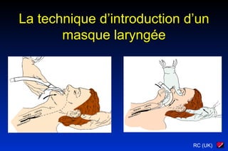 RC (UK)
La technique d’introduction d’un
masque laryngée
 