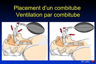 RC (UK)
Placement d’un combitube
Ventilation par combitube
 