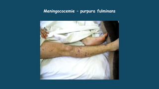 Meningococemie – purpura fulminans
 