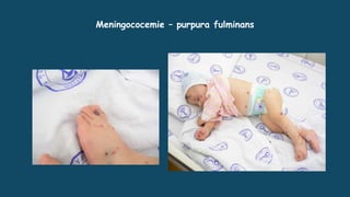 Meningococemie – purpura fulminans
 