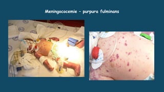 Meningococemie – purpura fulminans
 