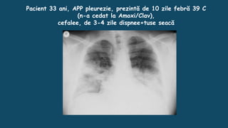Pacient 33 ani, APP pleurezie, prezintă de 10 zile febră 39 C
(n-a cedat la Amoxi/Clav),
cefalee, de 3-4 zile dispnee+tuse seacă
 