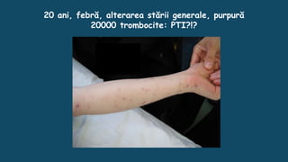 20 ani, febră, alterarea stării generale, purpură
20000 trombocite: PTI?!?
 