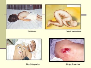 Opistótonos Plegaria mahometana
Decúbito pasivo Riesgo de escaras
 